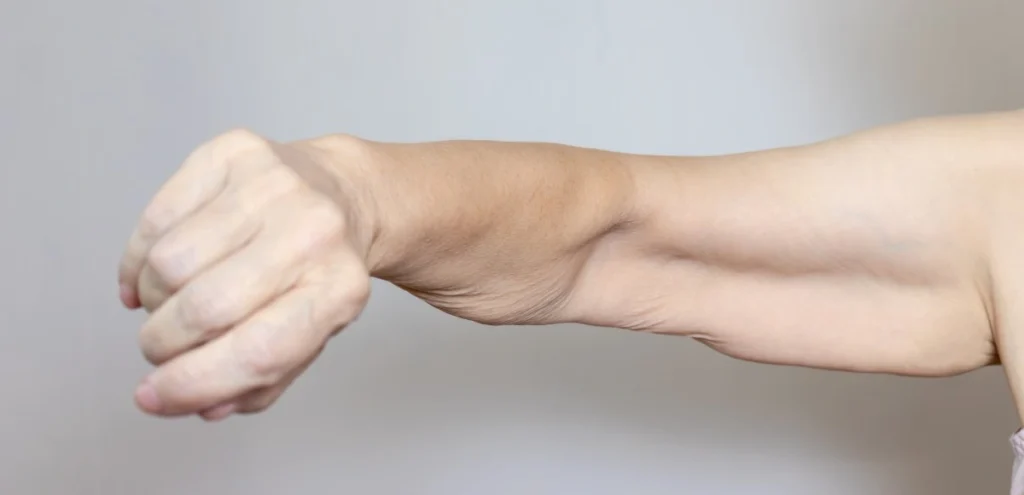 Cataplexy — Sudden Loss of Muscle Control