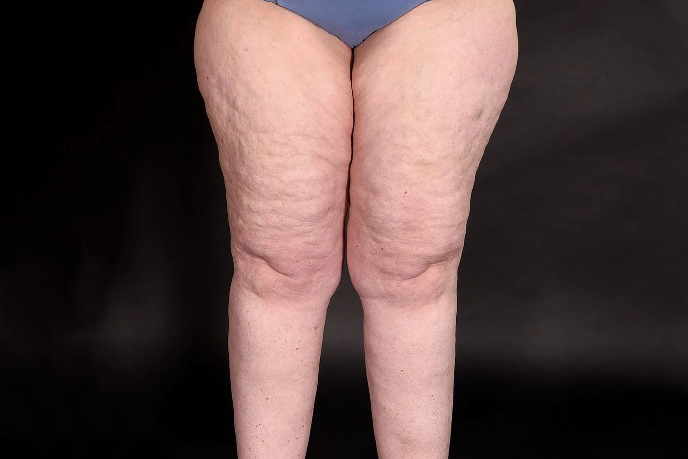 10 Key Difference Between Cellulite and Lipedema 5 Causes of Cellulite vs Lipedema — What Science Says