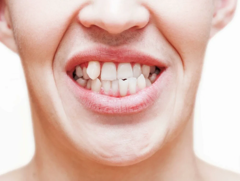 Why Does My Jaw Keep Locking? 12 Causes & Fixes 10 Dental Issues Misalignment Bite Problems More