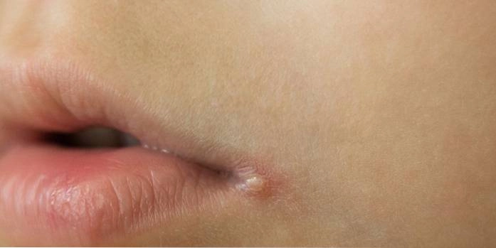 10 Fast Ways to Heal a Cold Sore Corner of Mouth 3 Early Signs of Cold Sore Corner of Mouth
