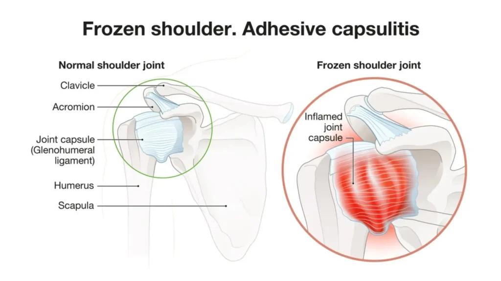 10 Causes of Pain in Upper Right Arm Between Elbow & Shoulder 11 Frozen Shoulder Adhesive Capsulitis