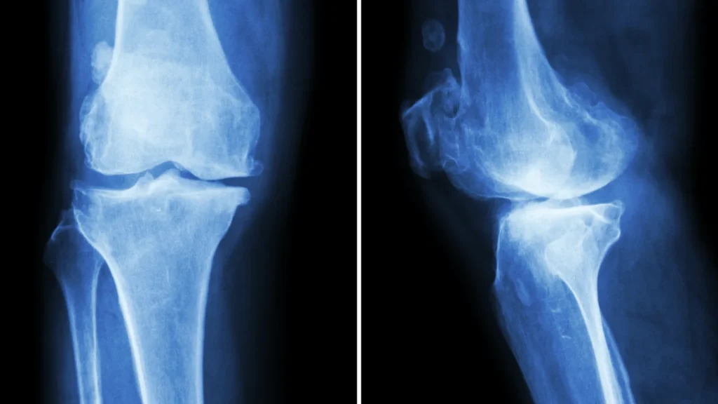 How Long Do Osteoarthritis Flare-Ups Last? 10 Causes & Treatment 3 How long Do Osteoarthritis Flare Ups last Science Behind the Pain