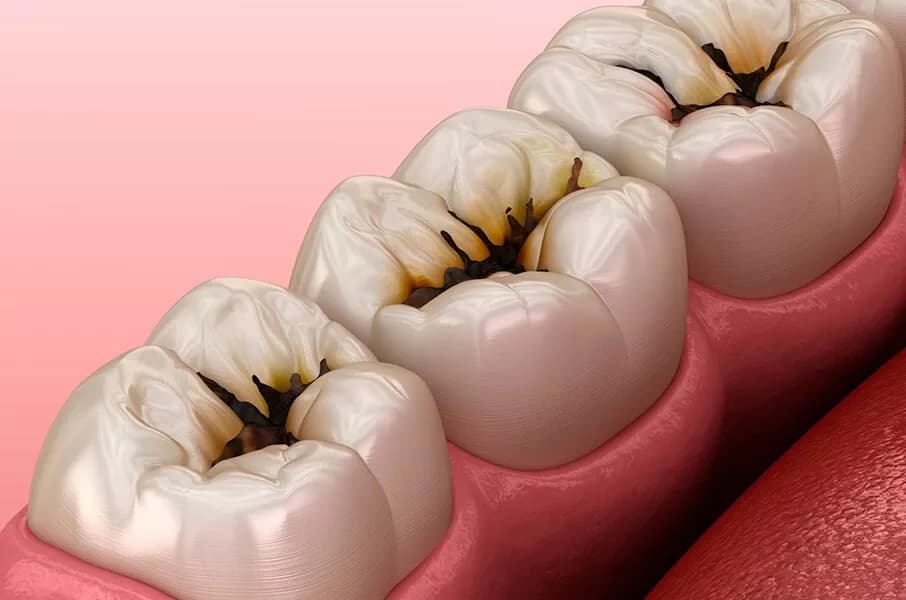 A close-up 3D illustration showing four molar teeth with visible cavities and decay on their chewing surfaces, set against a pink background.