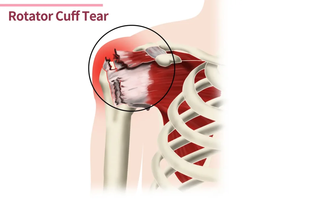 10 Causes of Pain in Upper Right Arm Between Elbow & Shoulder 12 Rotator Cuff Injury or Tear 3