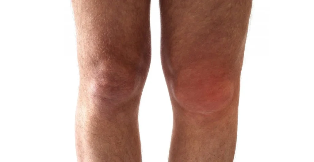 How Long Do Osteoarthritis Flare-Ups Last? 10 Causes & Treatment 6 Swelling and Warmth in Joints