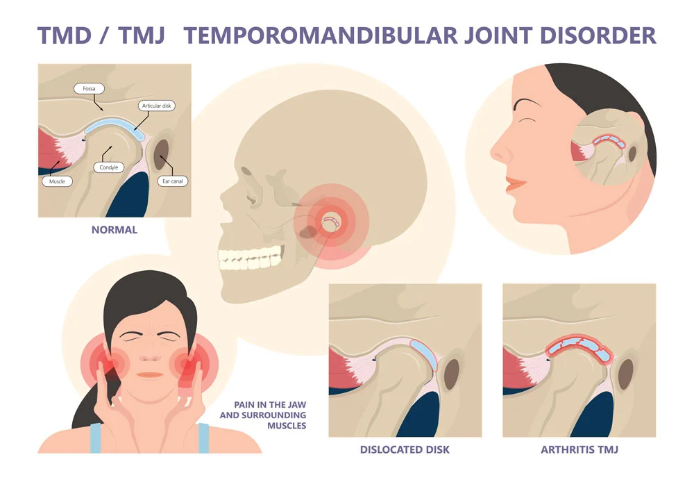 Why Does My Jaw Keep Locking? 12 Causes & Fixes 4 Temporomandibular Joint Disorder TMJTMD
