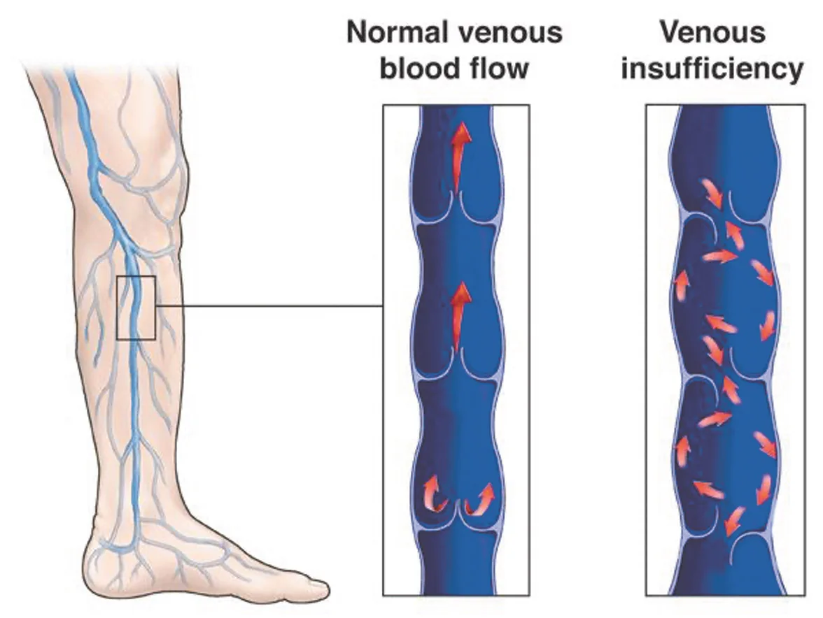 Sudden Bulging Veins in Hands With Pain: 10 causes 10 Venous Insufficiency