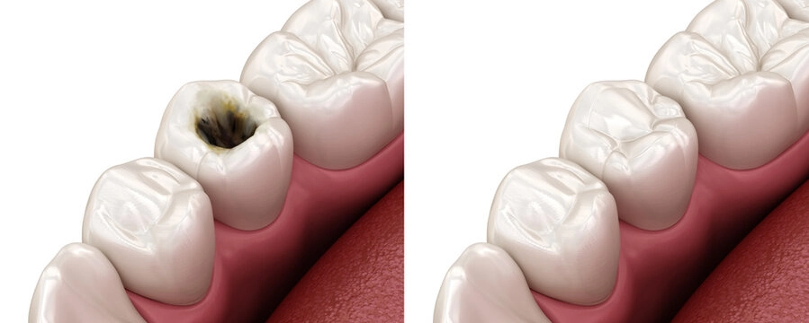 How to Tell If You Have a Cavity: 5 Clear Symptoms 3 What Exactly Is a Cavity And Why It Happens