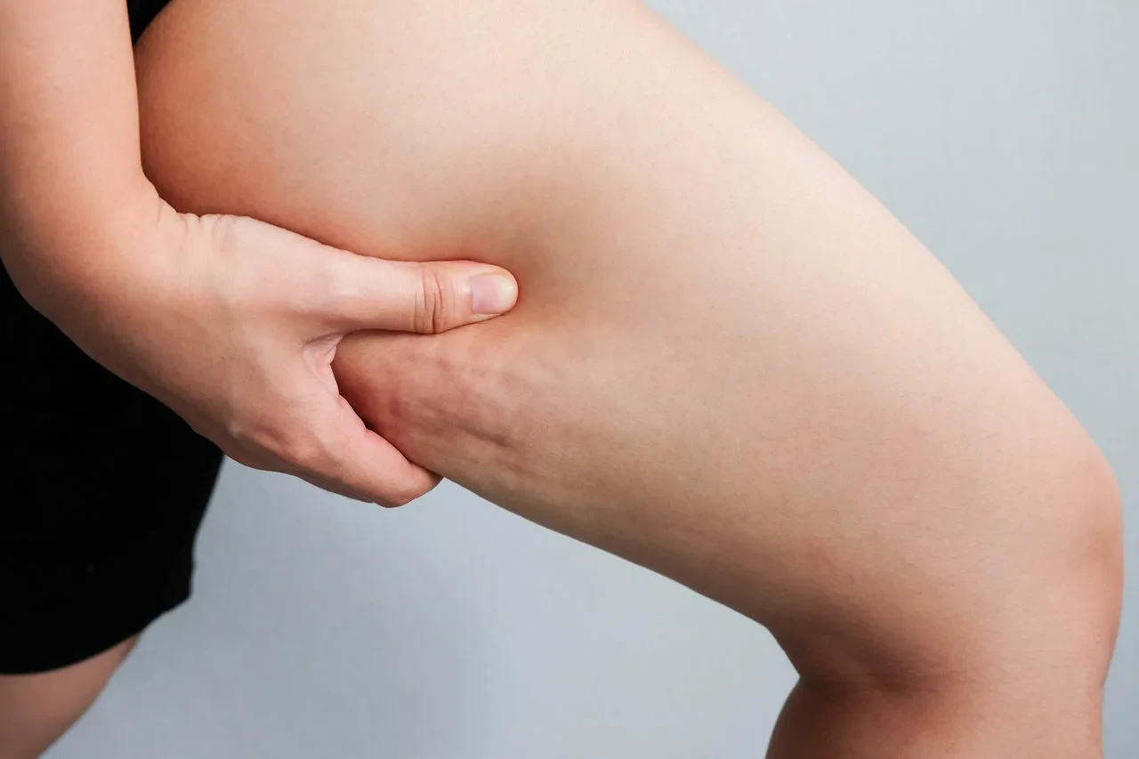 10 Key Difference Between Cellulite and Lipedema 3 What Is Cellulite The Common Skin Dimpling