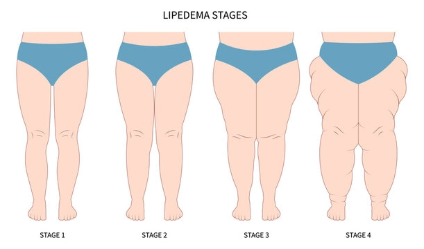 10 Key Difference Between Cellulite and Lipedema 4 What Is Lipedema The Often Misdiagnosed Fat Disorder