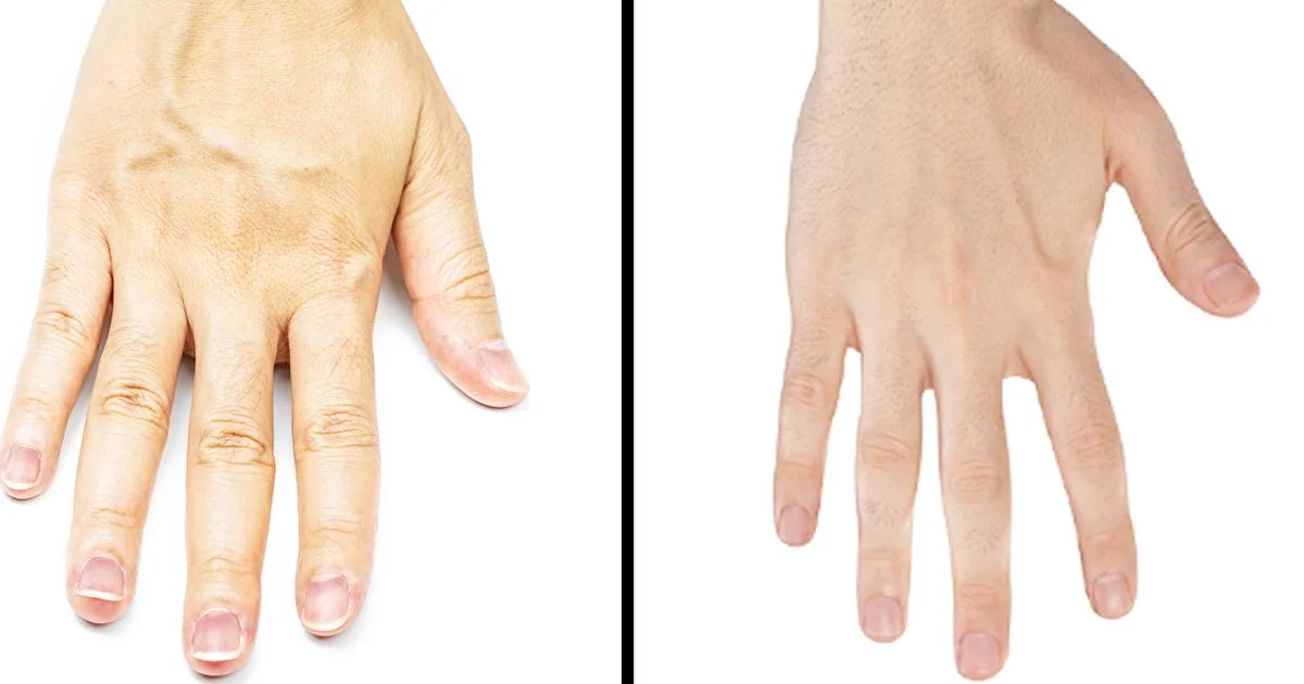 Sudden Bulging Veins in Hands With Pain: 10 causes 5 Why Veins Appear More Visible Skin Fat and Hydration