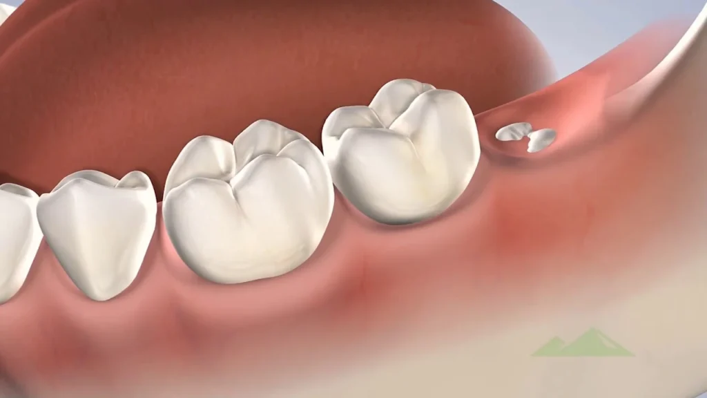 A digital illustration of three molar teeth in the gums, with the fourth molar partially visible and impacted beneath the gum line, indicating an unerupted wisdom tooth.