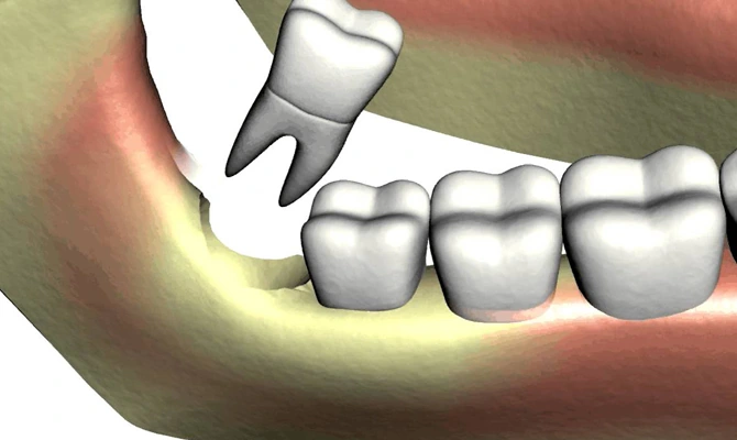 How Long Does It Take for Wisdom Teeth Holes to Close