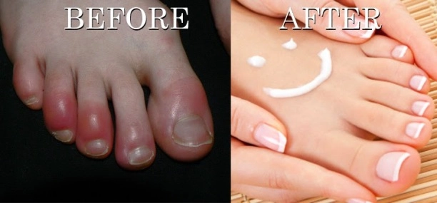 Inflammation Early Healing