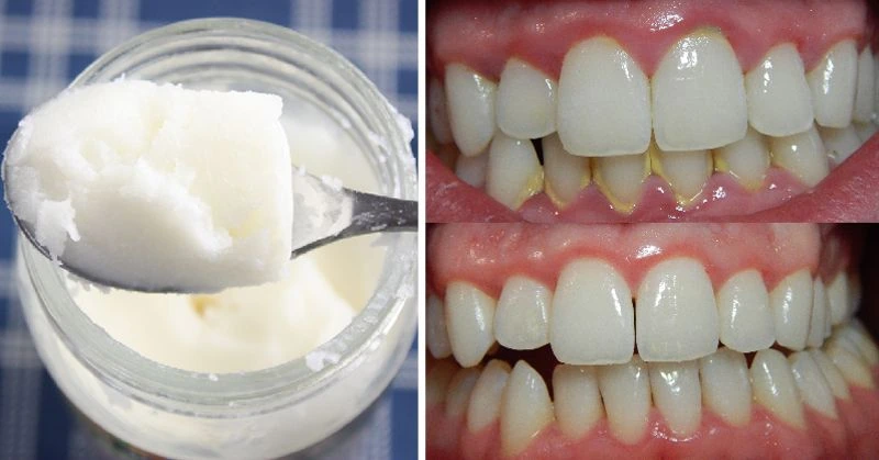 Oil Pulling The Ancient Detox for Whiter Teeth