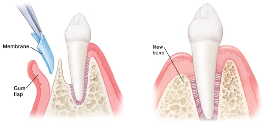 The Role of Bone Regeneration Beneath the Gums