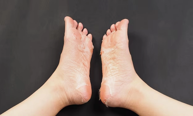 Thick Dead Skin Forms on Feet