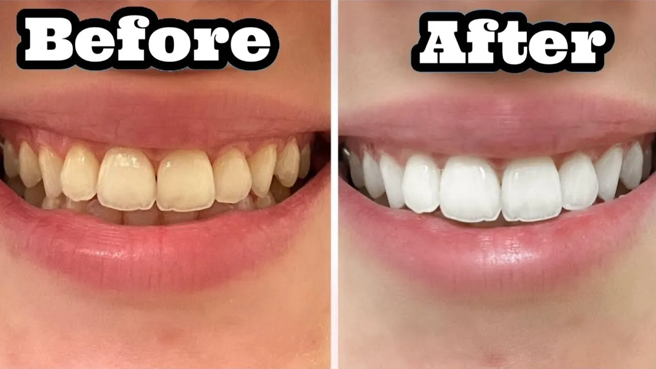 Understand What Causes Tooth Discoloration Before You Whiten