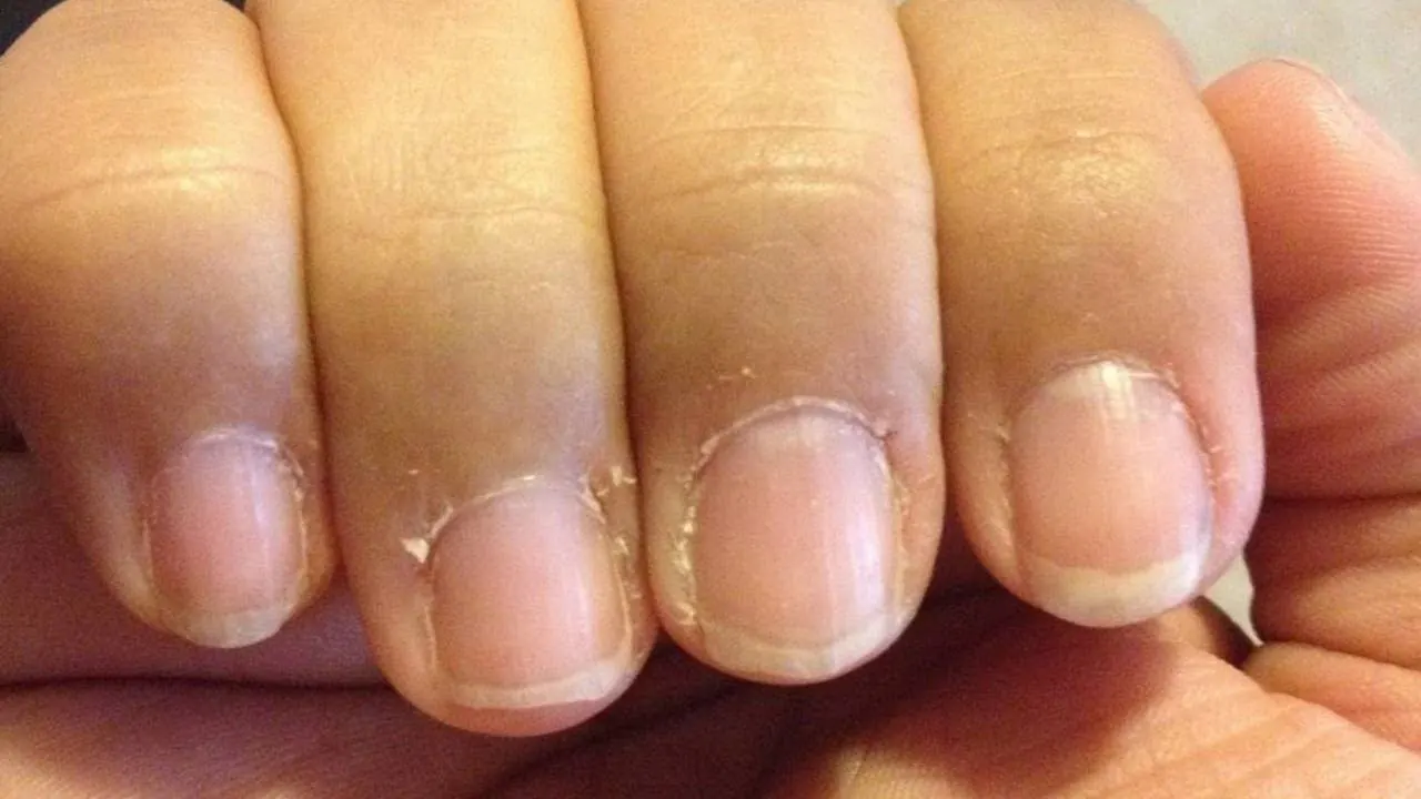 Understanding the Stages of Nail Regrowth After Removal