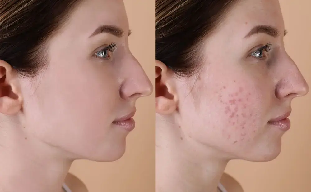 How Can Cosmetic Acne Scar Treatments Improve Skin